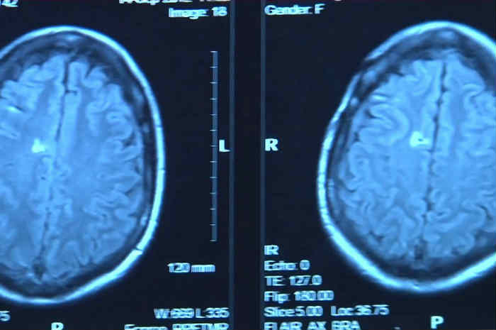 Aneurisma cerebrale: Sintomi, diagnosi, terapia e prevenzione