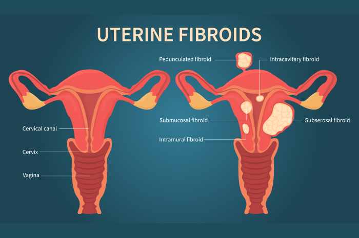 Fibromi uterini: sintomi, cause e trattamento