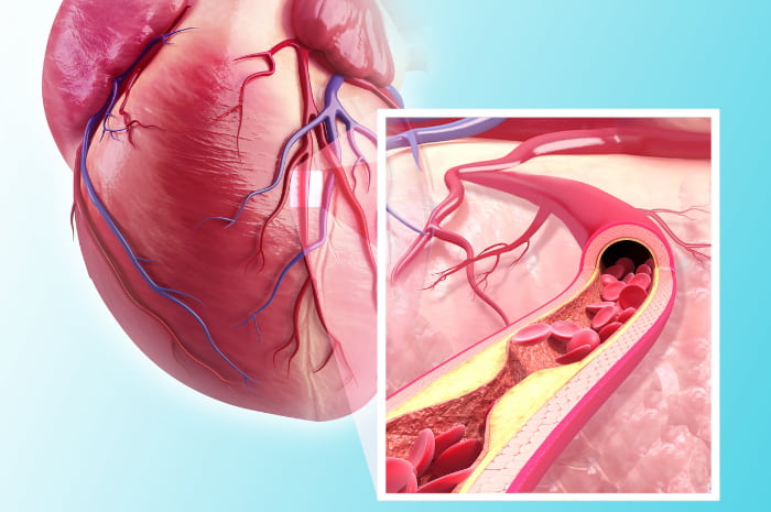 Arteriopatia obliterante periferica - PAD