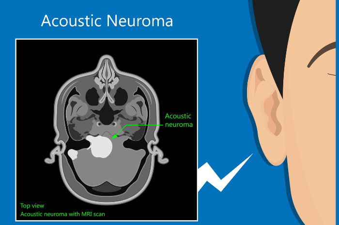Neurinoma acustico