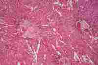 Amiloidosi, la malattia degli aggregati proteici