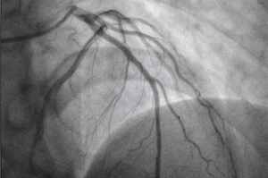 Benefici angiografia coronarica precoce dopo arresto cardiaco