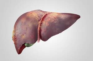 Tumore del fegato