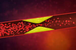 Ipercolesterolemia familiare omozigote