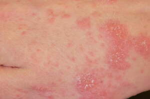 Bari, sospetta scabbia al Policlinico: 22 sanitari al Pronto soccorso