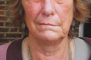 Paralisi di Bell: diagnosi, trattamento e importanza della riabilitazione