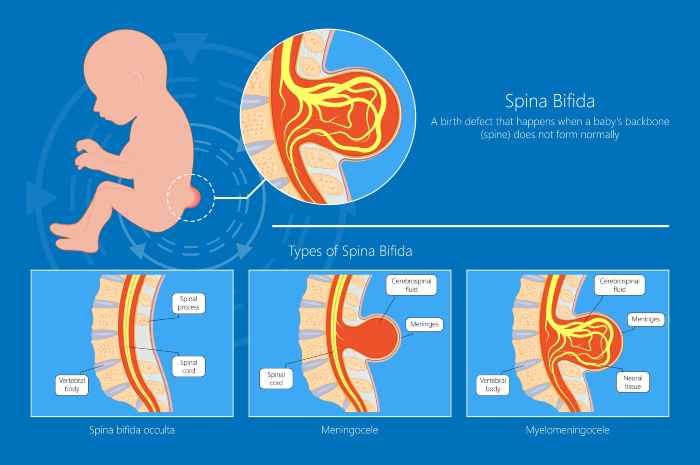 7. Spina Bifida Awareness Tattoo Designs - wide 7