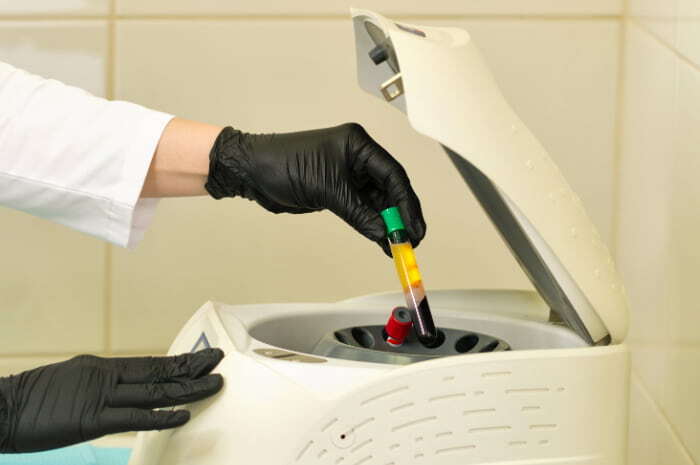 Plasma ricco di piastrine (PRP) nei siti donatori di innesto cutaneo