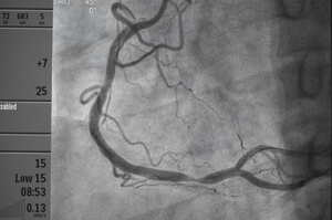 Sindromi coronariche acute: linee guida ACC/AHA 2025 