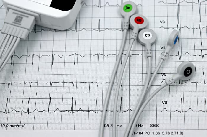ecg infarto