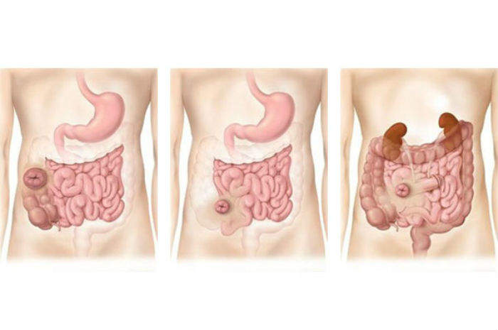 Tipologie e caratteristiche delle stomie intestinali