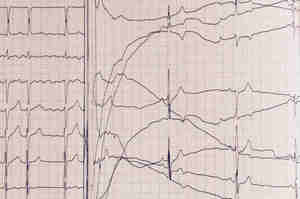 Cardioversione Elettrica e assistenza infermieristica