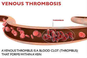 Tromboembolismo Venoso: prevenzione, diagnosi e terapia