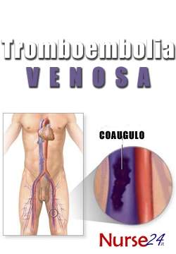 Tromboembolia venosa: una malattia cronica