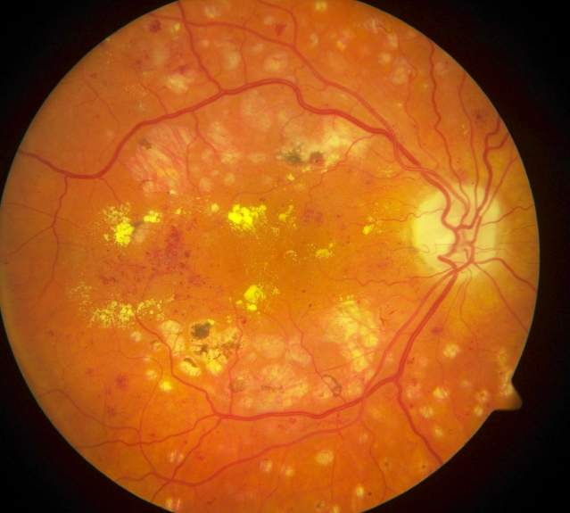 Retinopatia: è la principale causa di cecità in persone tra i 25 e i 60 anni