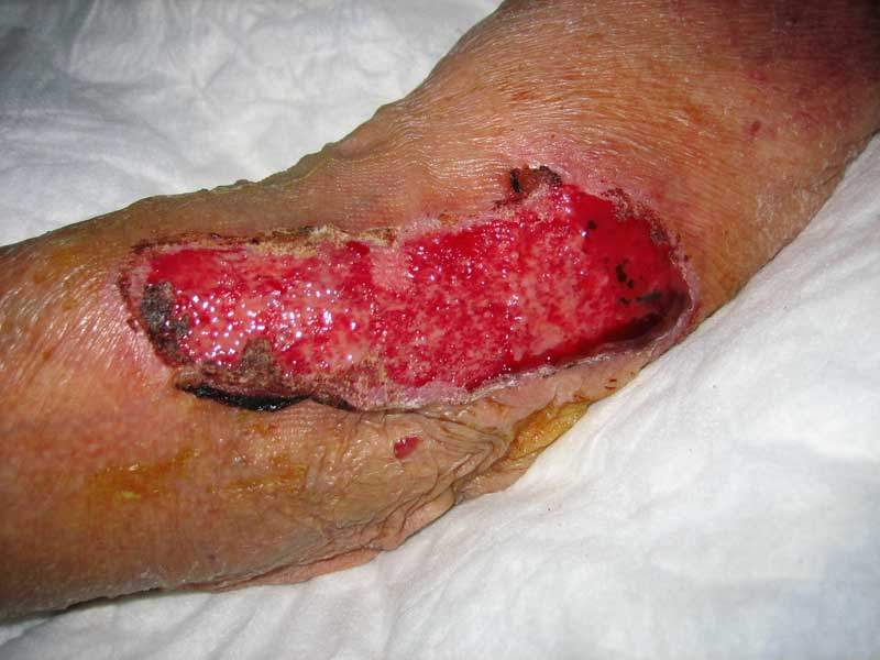 Lesioni cutanee: quali fattori ne compromettono la guarigione?