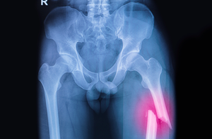 Infermiere chirurgia ortopedica: gestione frattura del femore